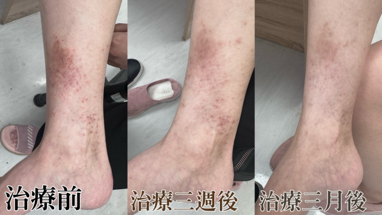 異位性皮膚炎治療前、治療三週後、治療三個月後的皮膚變化對比